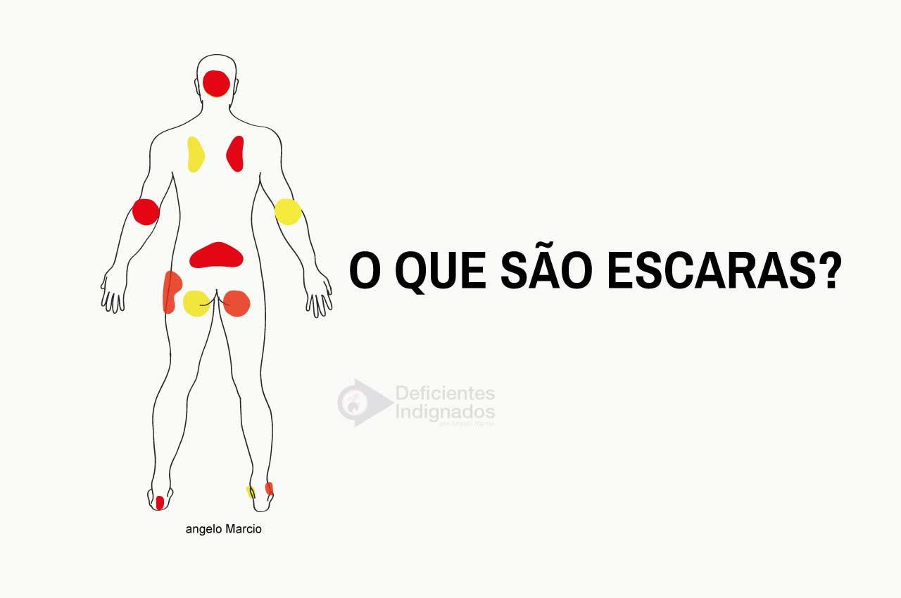 Desenho de um corpo de costas com marcas coloridas onde podem surgir escaras.