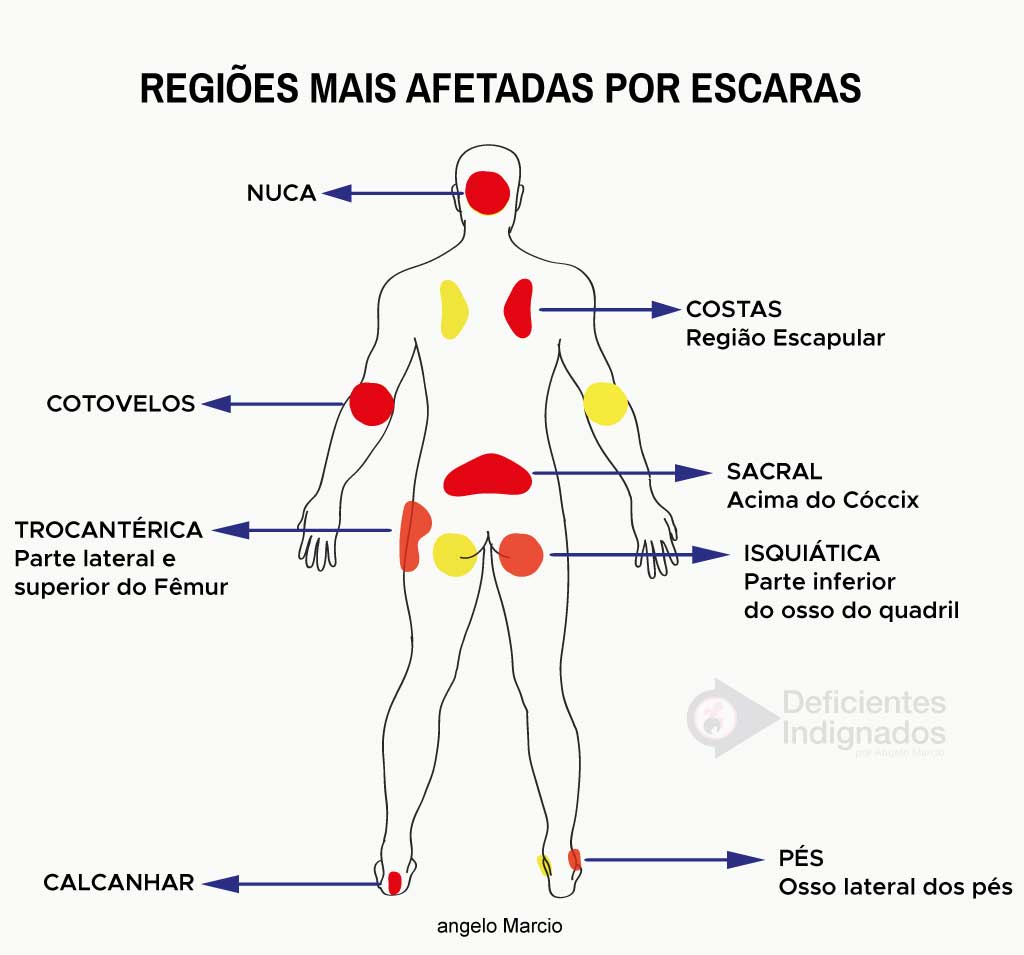 Desenho de um corpo com cores onde podem surgir as escaras.